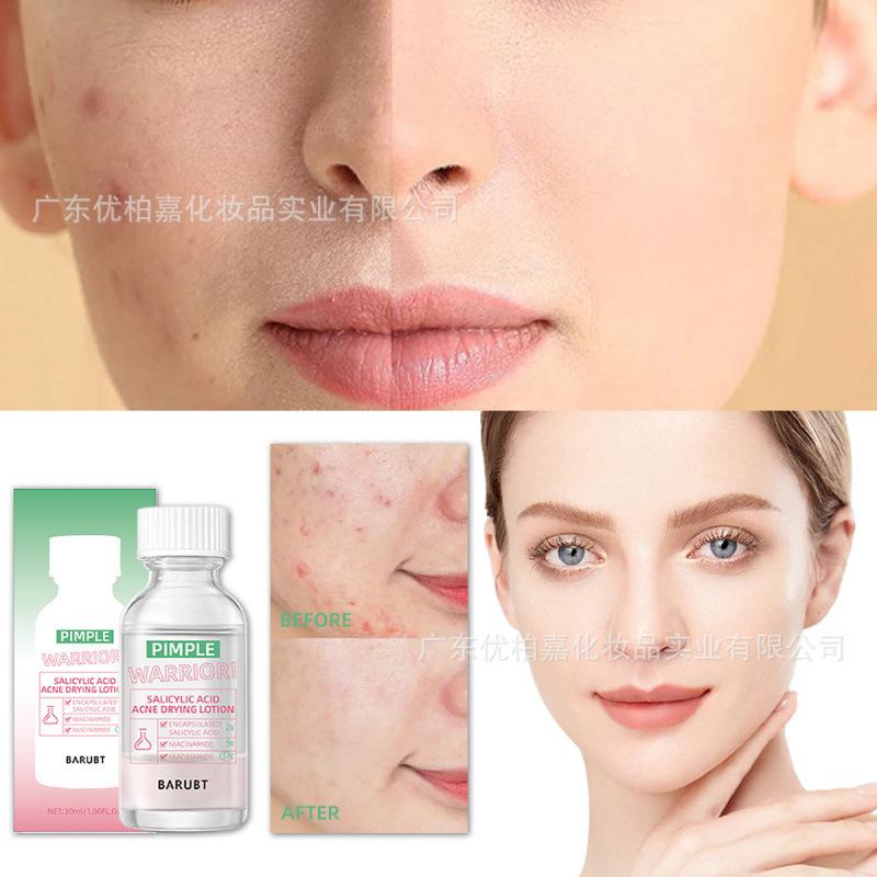 BARUBT Large Drops of Niacinamide Salicylic Acid Acne Essence, Quick Acne, Light Redness, Gentle Repair