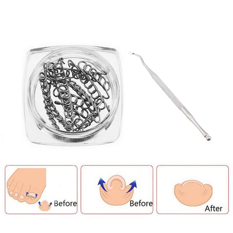 Ingrown Toe Nail Correction Wire Fixer Pedicure Paronychia Recover Toenails Corrector With Toe Correction Files Foot Care Tool