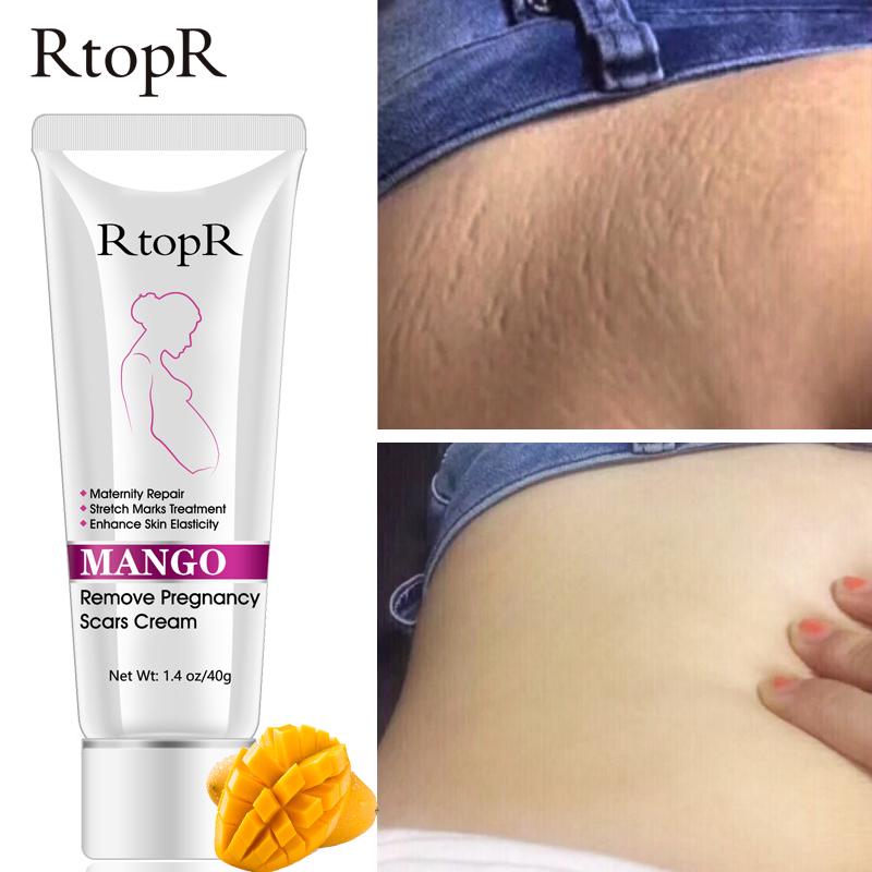 mango stretch mark cream