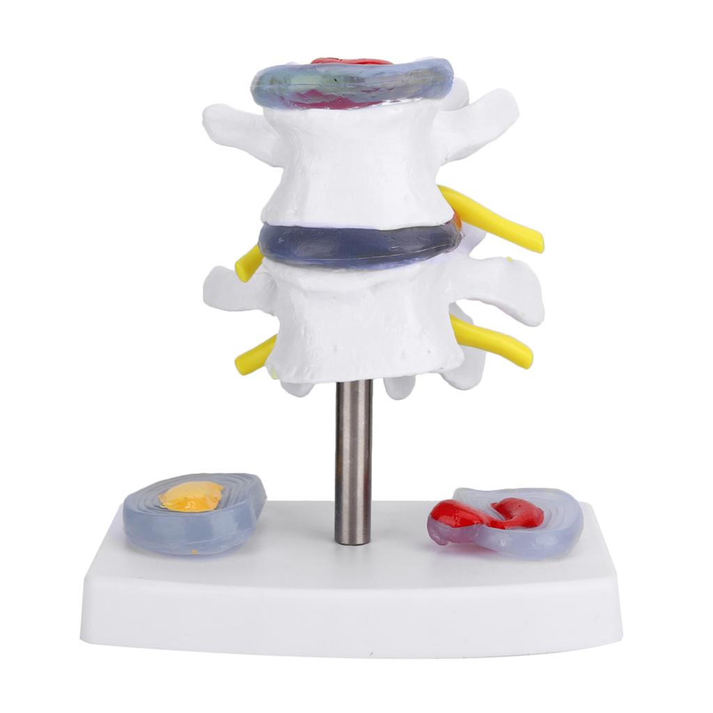 Anatomical Lumbar Disc Herniation Demonstration Model Human Spine School Training Supplies