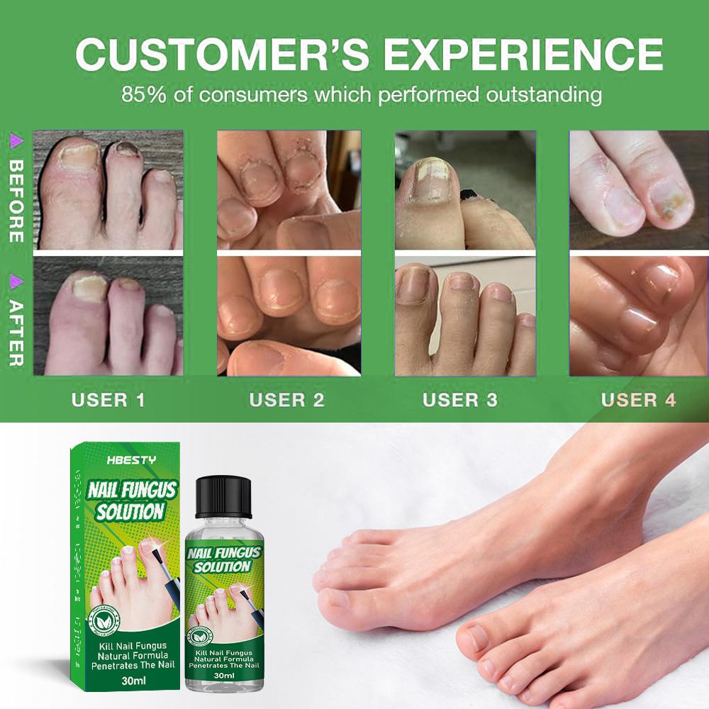 Hbesty Herbal Nail Fungus Treatment Liquid For Effective Foot Care And Healing