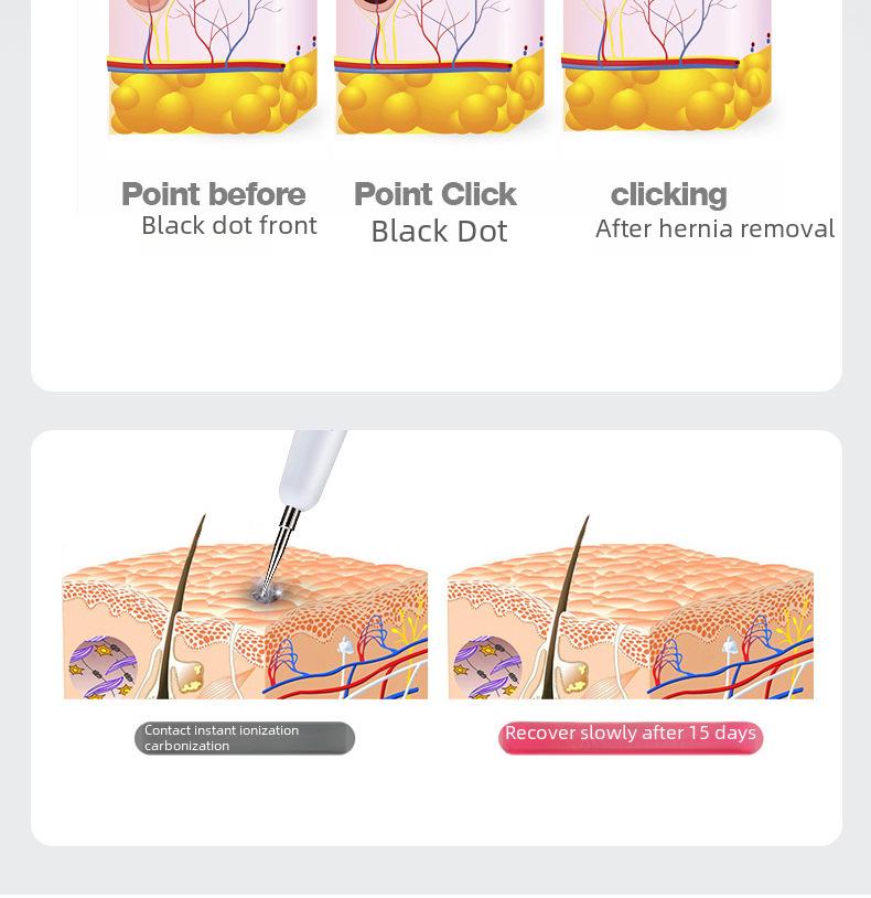 Stiftset zur Muttermalentfernung mit 12 Geschwindigkeiten: Gerät zur Muttermalentfernung, schwarzer Muttermalradierer, Augenbrauenreiniger, Reparaturcreme, spurloser Schönheitsstift.