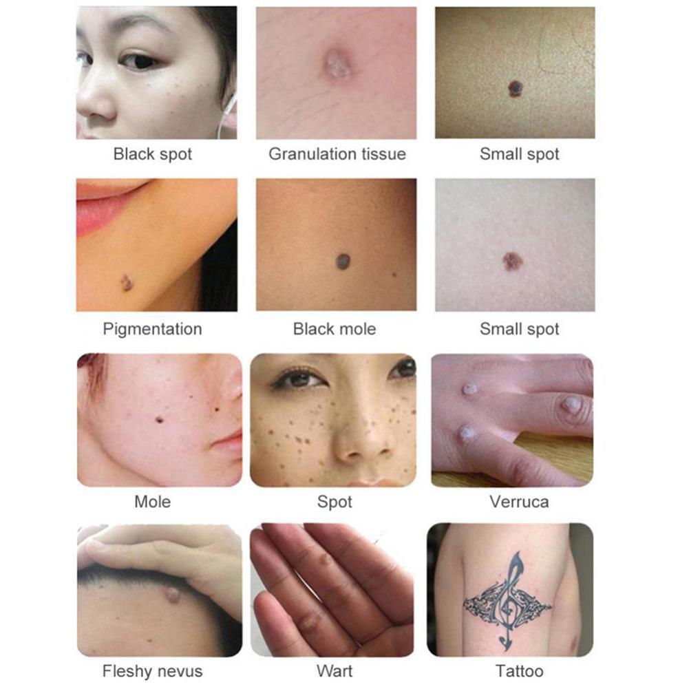 Ultrasonic Freckle Spots Removal Machine Detoxifying Face Care Machine for Home SalonUS Plug 110V