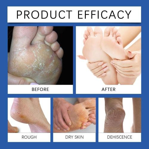 60% Urea Cream for Foot Use - Softens Dead Skin Cells, Naturally Exfoliates, and Provides Excellent Moisturizing Properties for Dry, Cracked Skin. Ide