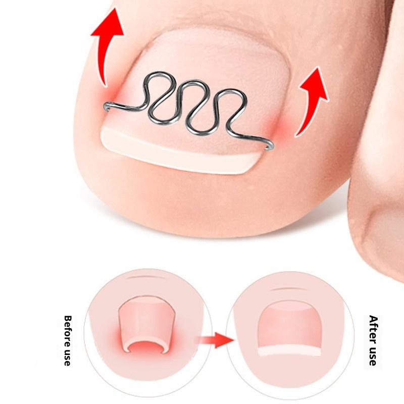 1 Pcs Ingrown Toenail Correction Tool Ingrown Toenail Treatments Elastic Patch Sticker Toenail Straightening Pedicure Tools