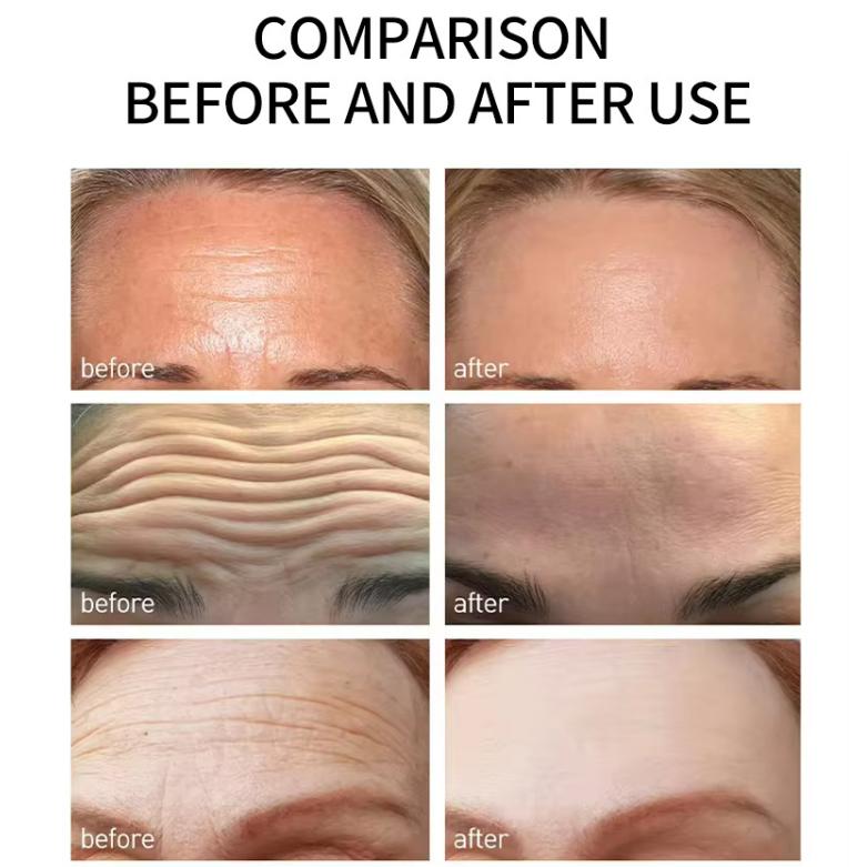 Faltenentferner Patches Anti-Aging Gesichtsmaske Säure Gesichts Mikrokristallin Hyaluron Lifting Aufkleber