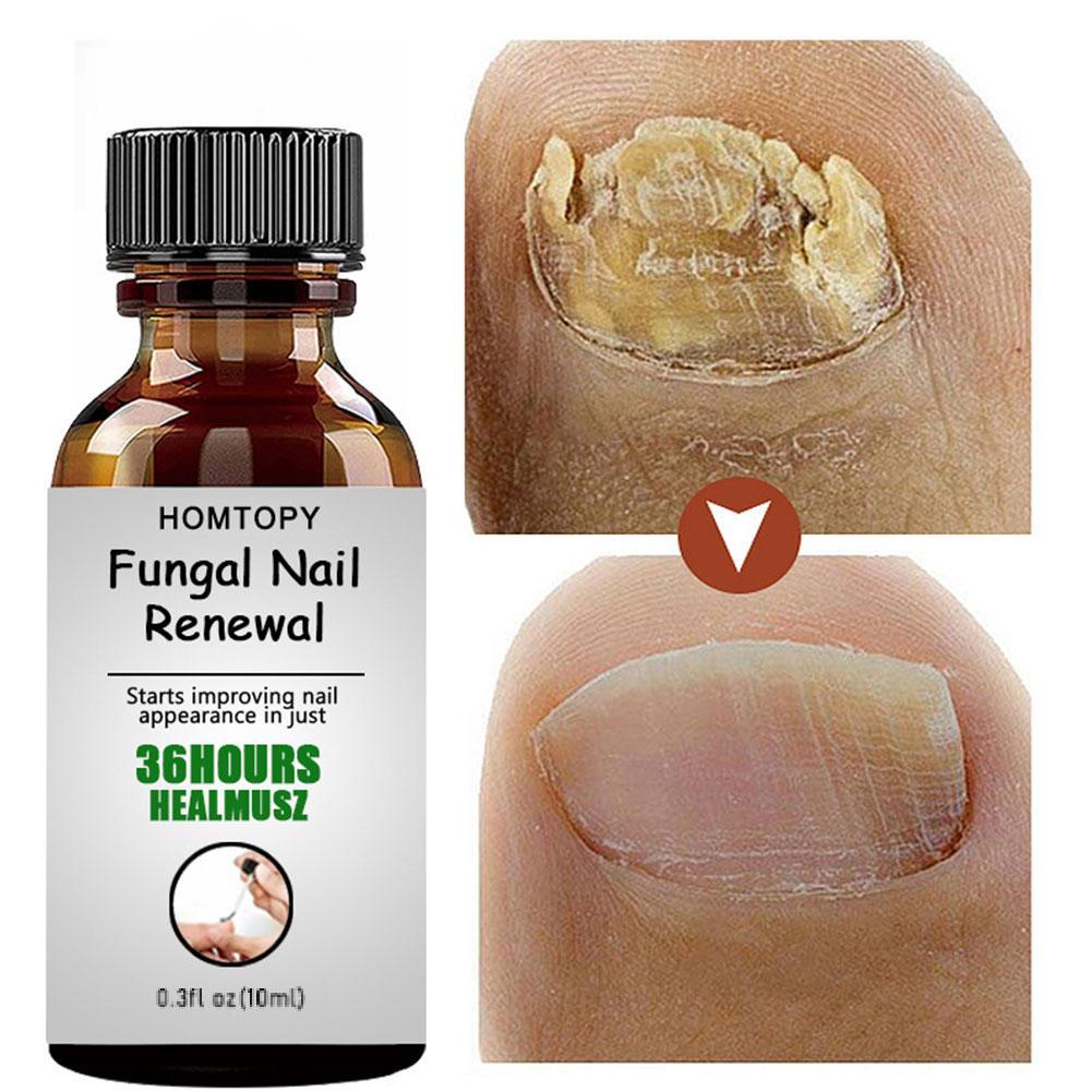 10ML Toenail Nail Fungus Treatment Repair Fingernail Device Foot Toenail Fungus Essential Care F0N3