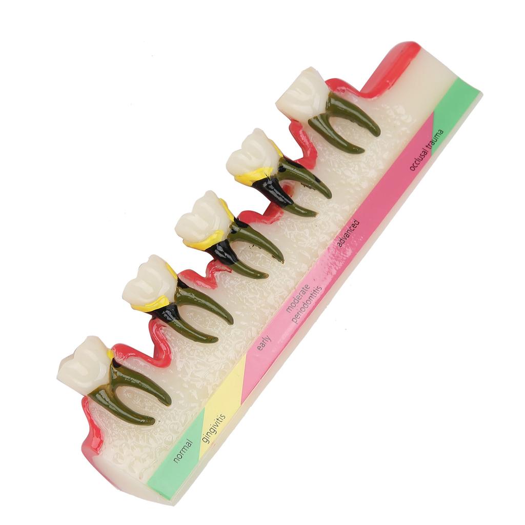 Dental Periodontal Disease Model Tooth Disease Study Teaching Model for Dental School