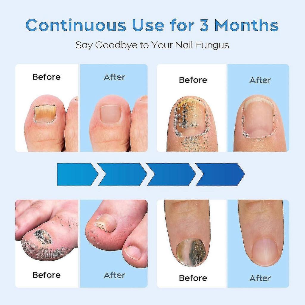 Nail Fungus Laser Treatment Device for Multiple Toenail, Home Use 905nm Infrared Light + 470nm Blue Light Toe Nail Fungus Device