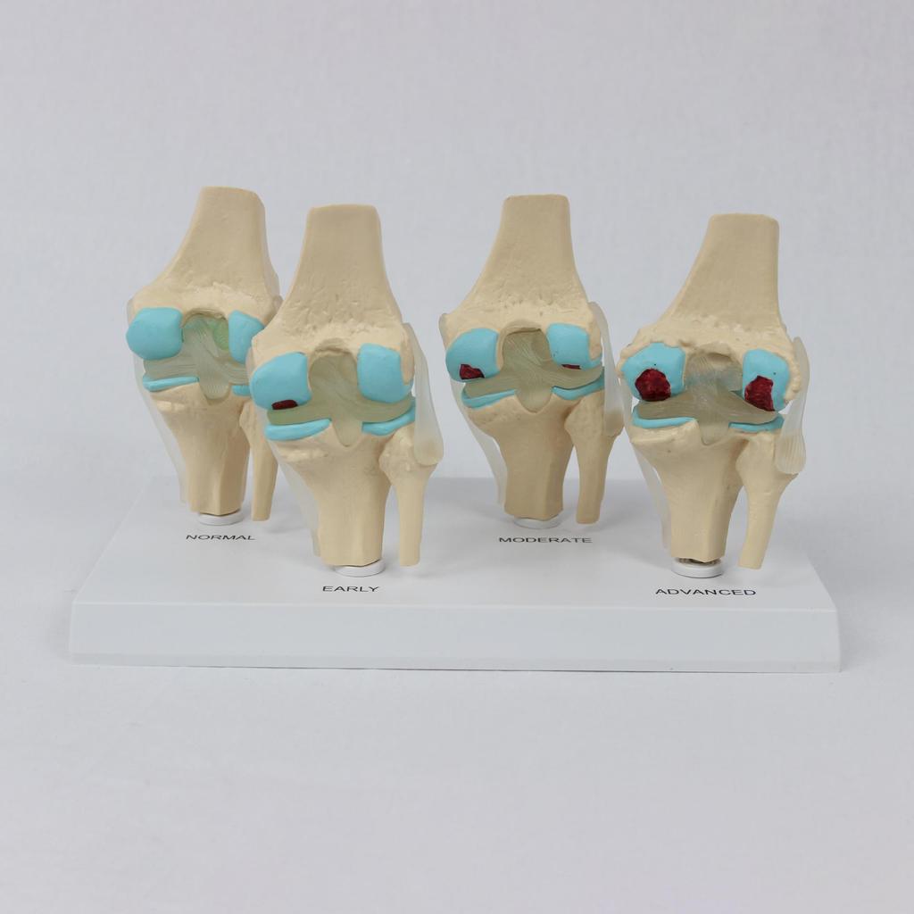 4-Stage Human Knee Evolution Model for Teaching and Display