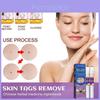 Eelhoe Body Mole Removal Pen Effective Skin Tag Remover For Face Hands And Neck