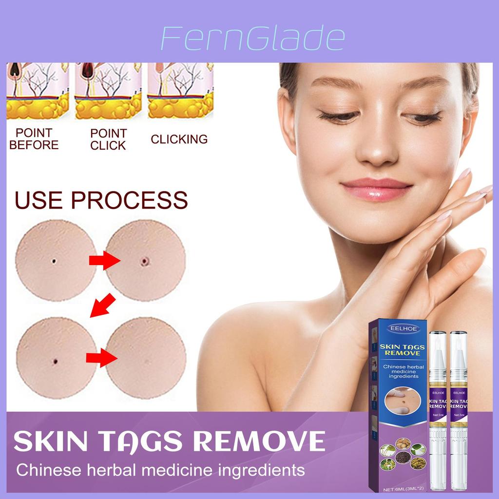 Eelhoe Body Mole Removal Pen Effective Skin Tag Remover For Face Hands And Neck