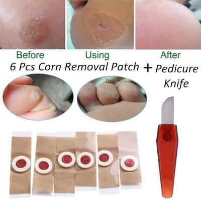 6 Pcs/set Foot Corn Removal Killer Calluses Plantar