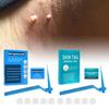 Effective Skin Tag Removal Tag Refill Band Set With 10 Pieces For Smooth Skin