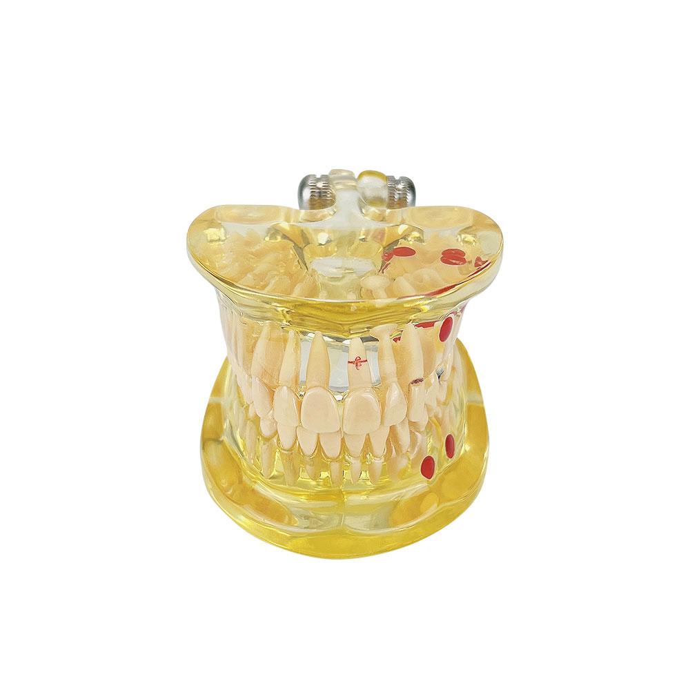 Dental Teeth Model With Removal Teeth Dental Models For Patient Education Transparent Jaw Model Dentistry Pathology Typodont New