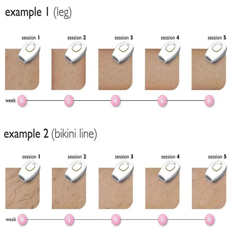 Appareil d'épilation laser IPL compact pour usage domestique et clinique