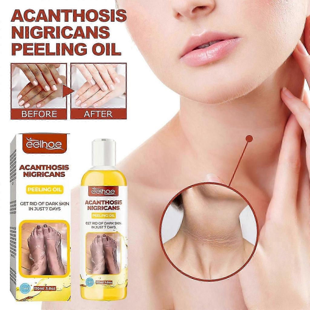 Eelhoe Acanthosis Nigricans Exfoliating Oil Brightens And Brightens The Complexion Of Armpits And Joints, Cleanses And Moisturizes The Skin
