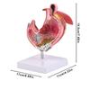 Diseased Stomach Model Stomach Anatomy Model Pathological Stomach Model For Medicals Students And Healthcare Learning