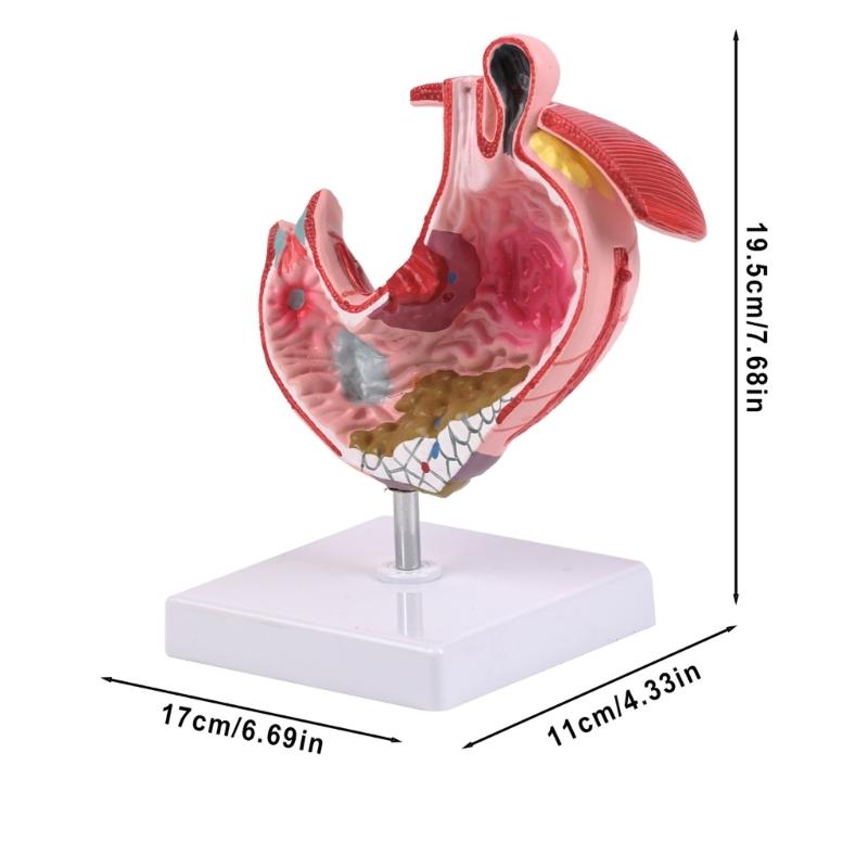 Diseased Stomach Model Stomach Anatomy Model Pathological Stomach Model For Medicals Students And Healthcare Learning