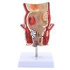 Human Pathologies of Rectum Model Medicals Teaching Tool Human Rectum Model Human Anatomy Model Teaching Supplies