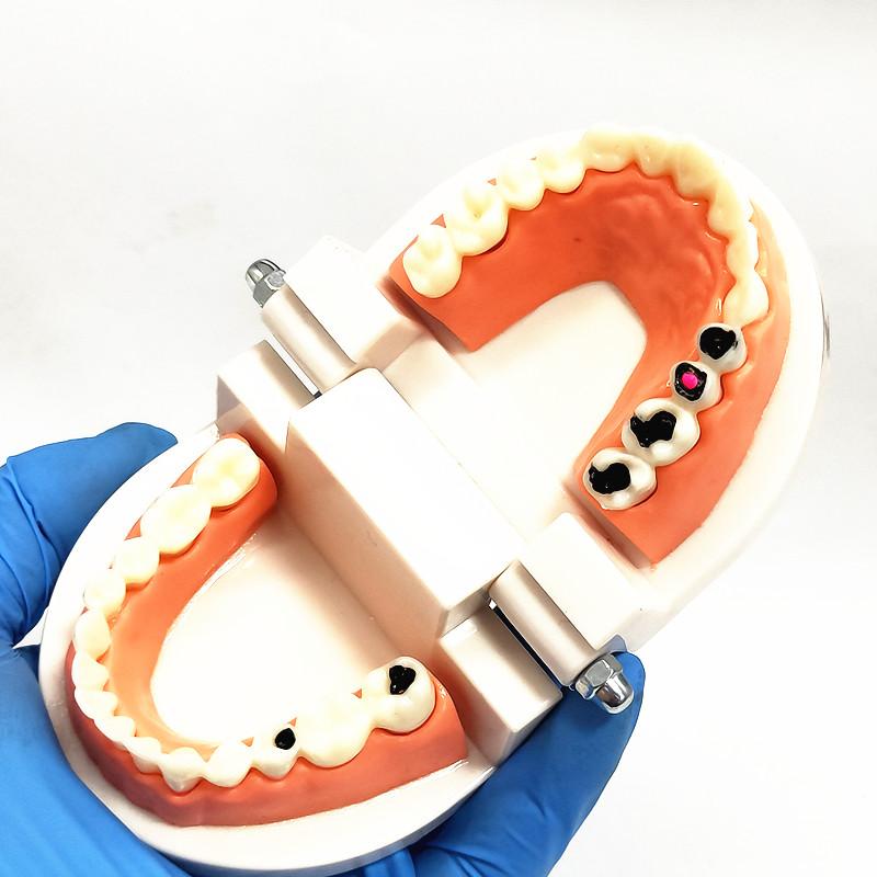 1 Piece Dental Tooth Model Standard Teeth Model Dental Caries Model for Patient Communication Dentist Study Model with Decayed Tooth