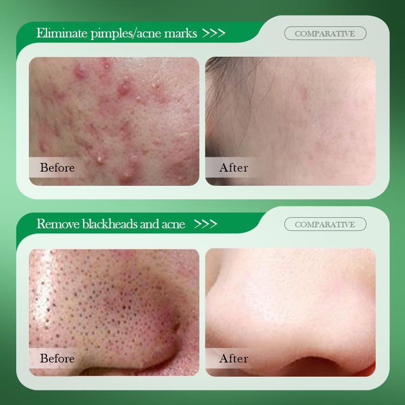 Maschere in fogli Sadoer Trattamento Acne con Acido Salicilico con Benefici Idratanti Per Tutti i Tipi di Pelle 110g 55 Fogli