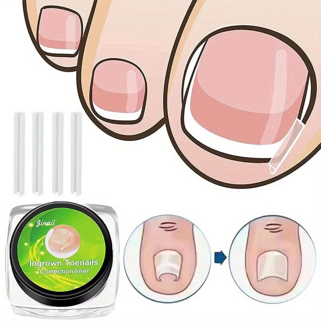 10Pcs Toenail Straightening Clippers Toenail Correction Tools Set Nail Care Elastic Stickers Pedicure Foot Care Tools
