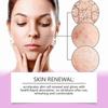 2025 Latest Model  Azelaic Acid Anti-Acne Repair Cream To Reduce Acne And Improve Redness