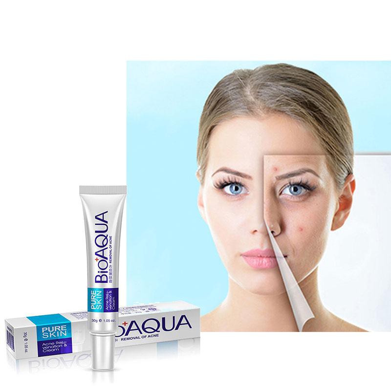 BIOAQUA Creme zur Entfernung von Aknenarben, Gel, Anti-Akne-Behandlung, Gesichtsaufhellungscreme, Ölkontrolle, Verblassen dunkler Flecken, Hautpflege