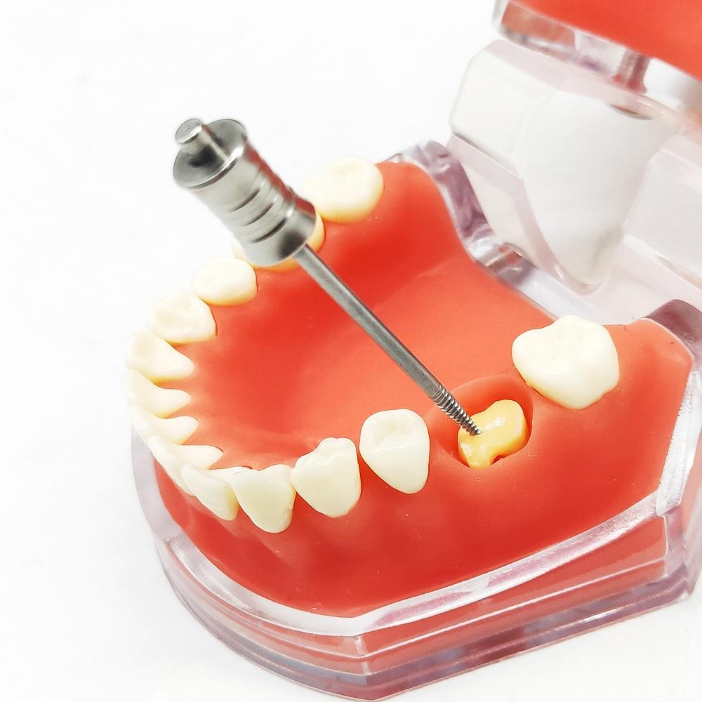 1 Stück oder 3 Stück Zahnwurzel-Zahnextraktionsschraube Zahnwurzelschraubenextraktor Apikale Wurzelfragmente Werkzeuge Zahnärztliche Werkzeuge für gebrochene Wurzeln Medizinisch