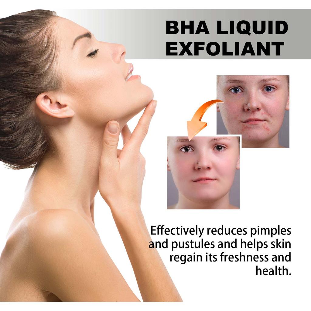 Hoygi Salicylic Acid Acne Clear Serum, Improves Acne, Fades Acne Marks, Tightens Pores, and Moisturizes the Skin. Suitable for the Face, 118ml