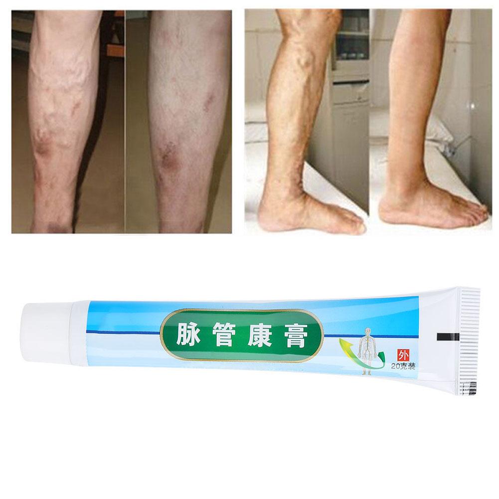 Phlebitis Varicose Vascular Inflammation Ointment Veins Collapse Treatment Cream
