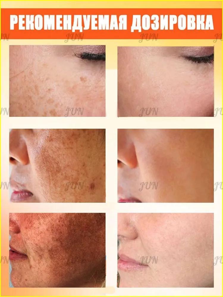 Retiderm anti-aging face cream, Freckle removal and whitening cream is able to remove freckles, chloasma, sunspots, age spots, Contains hyaluroni