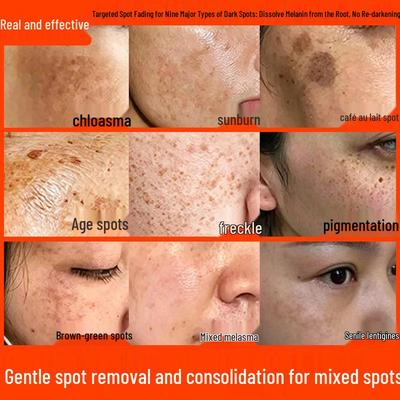 Crema Iluminadora para Melasma, Pecas, Manchas Solares y de Edad - Desvanece la Melanina y la Opacidad, Mejora el Tono de la Piel