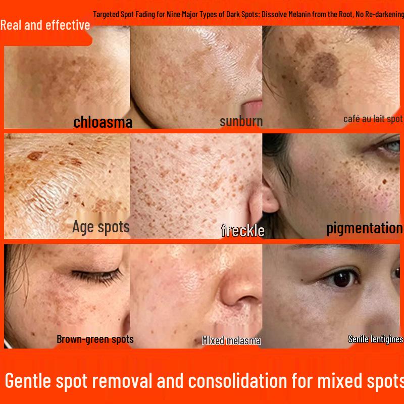 Brightening Cream for Melasma, Freckles, Sun & Age Spots - Fades Melanin & Dullness, Enhances Skin Tone