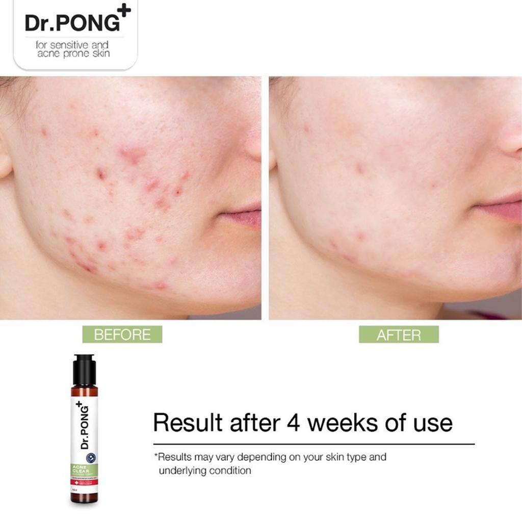Dr.PONG+ Acne Clear Glowing Toner, Tea Tree Oil, Niacinamide, BHA, Zinc PCA, 100 Ml. X 1 / 3 Pcs