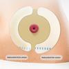 10Pcs Barrier Stoma Ostomy Strips Tape Strip Rings Adhesive Pressure Fixing Colostomy Leak Proof Colostomy Bag Barrier Strip